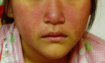 [:en]Systemic Lupus Erythematosus[:km]ជម្ងឺ SLE[:]