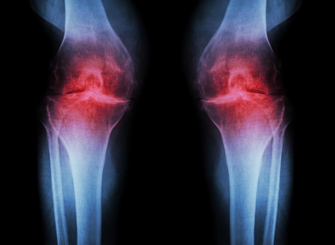 [:en]Osteoarthritis[:km]ជម្ងឺរលាកសន្លាក់[:]