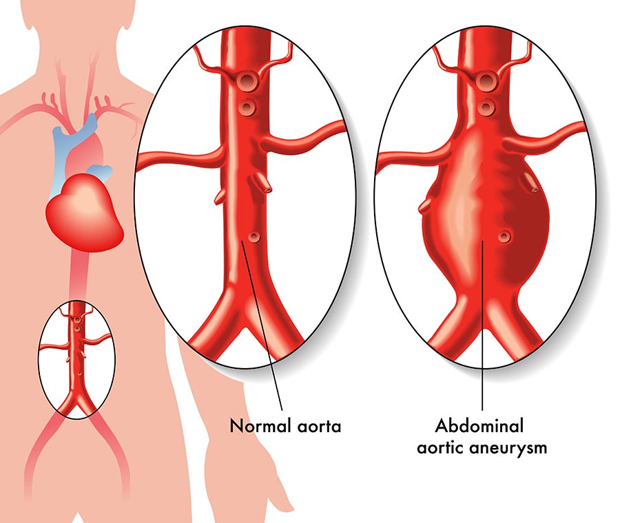 ដុំពកសសៃឈាមអាអ័កក្នុងពោះ (Abdominal Aortic Aneurysm)