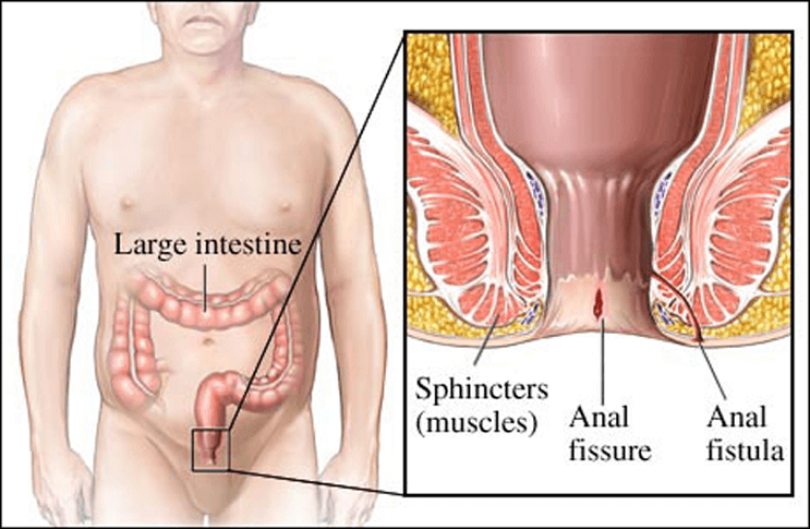 បូសអន្ទង់ (Anal fistula)