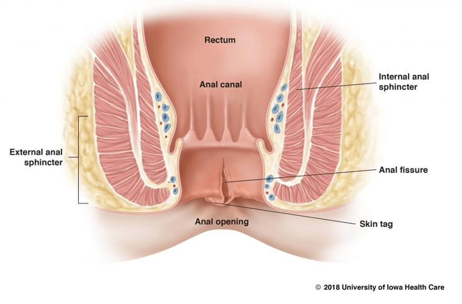 ការដាច់រន្ធគូថ (Anal fissure)