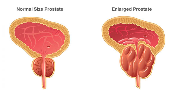 ការរីកក្រពេញប្រូស្តាត (BPH: Benign Prostatic Hyperplasia)