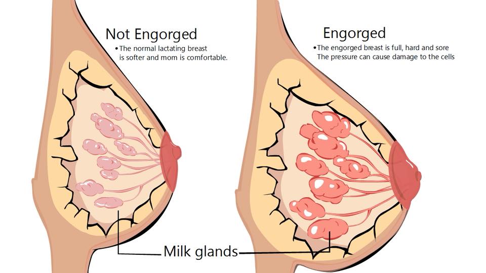 ការឡើងដោះ (Engorged Breasts)
