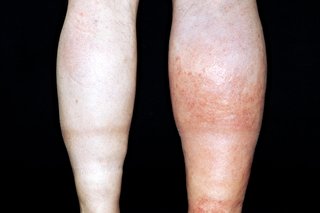 ការស្ទះសរសៃឈាមវ៉ែនជ្រៅ (Deep Vein Thrombosis)
