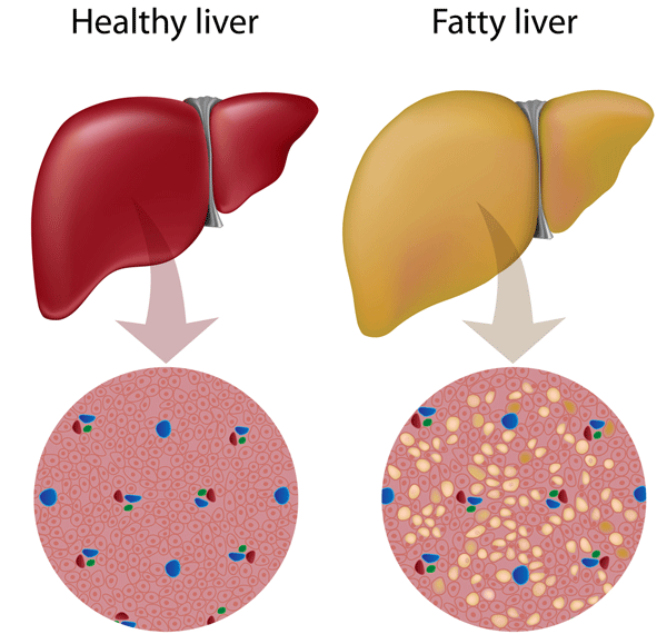 ជំងឺខ្លាញ់រុំថ្លើម (Fatty Liver Disease)