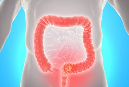 ជំងឺមហារីកពោះវៀន (Colon Cancer)