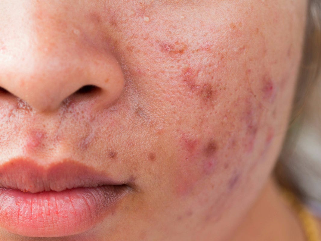 មុន (Acne)