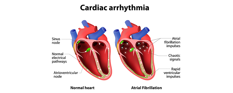 ចង្វាក់បេះដូងមិនប្រក្រតី (Arrhythmia)