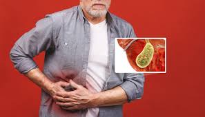 គ្រួសក្នុងថង់ប្រម៉ាត់ (Gallstones)