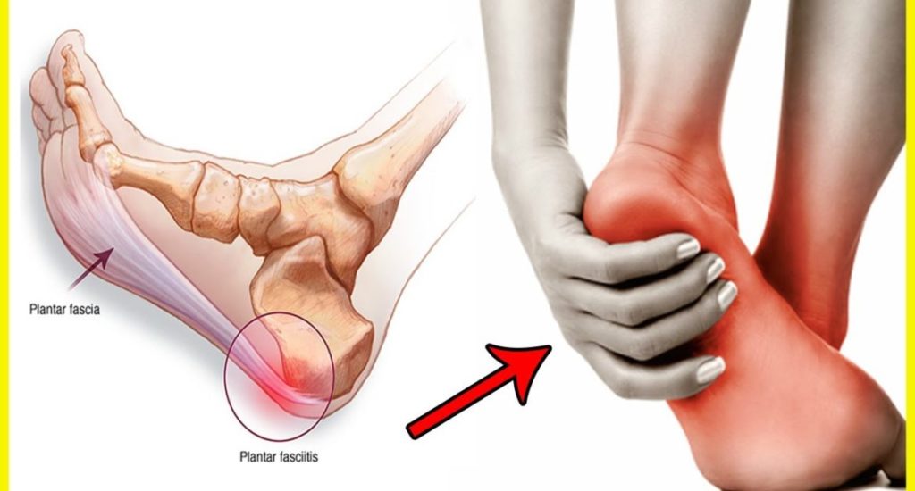 ជំងឺរលាកសសៃពួរបាតជើង (Plantar fasciitis)