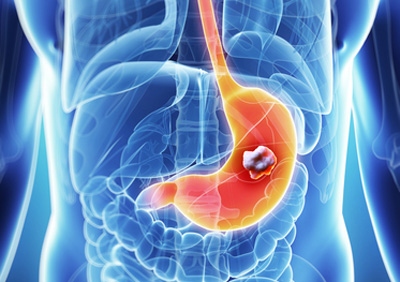 ជំងឺមហារីកក្រពះ (Stomach Cancer)