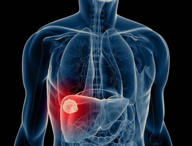 ជំងឺមហារីកថ្លើម (Liver Cancer)