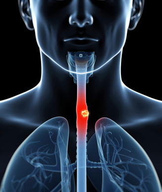 ជំងឺមហារីកបំពង់អាហារ (Esophageal Cancer)