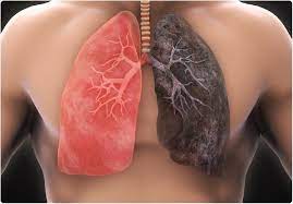 ជំងឺមហារីកសួត (Lung Cancer)