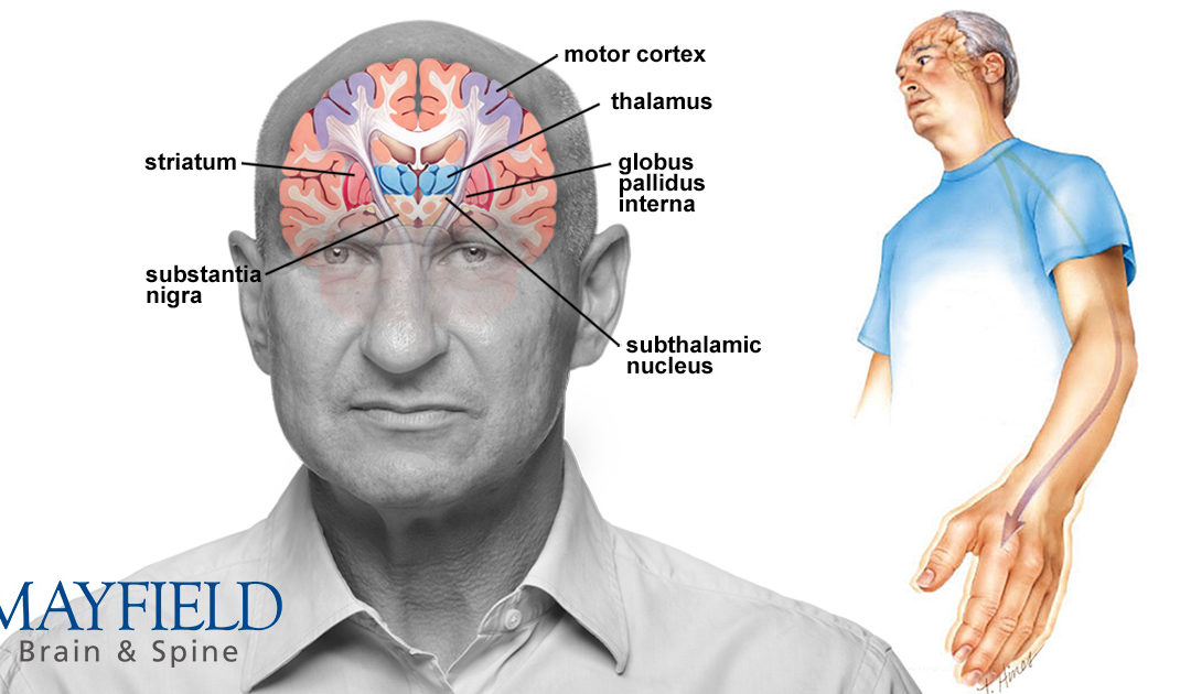 ជំងឺប៉ាគីនសុន (Parkinson’s Disease)