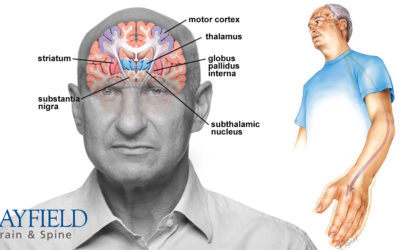 ជំងឺប៉ាគីនសុន (Parkinson’s Disease)
